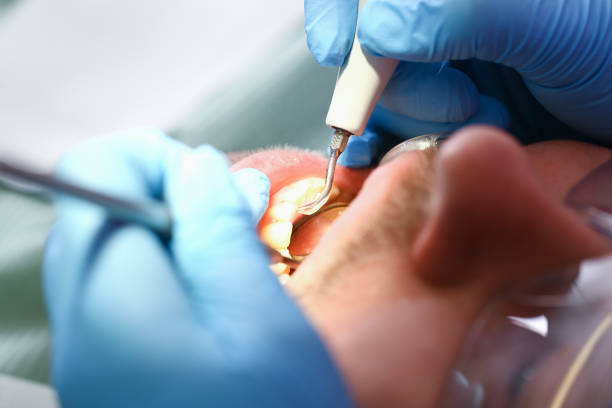 Best Emergency Treatment for Dental Infections or Abscesses in Amboy, WA